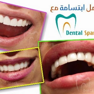 Dental Spark - خبراء تبييض الاسنان
